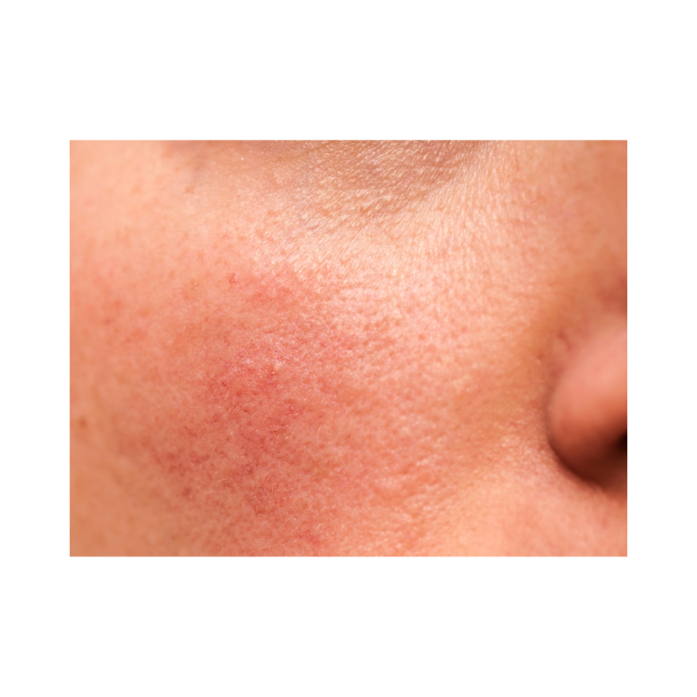 High PPD Sunscreens For PostInflammatory Erythema Skin Fit Well